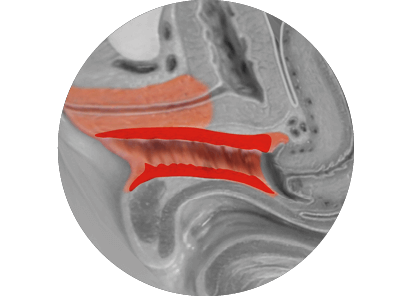 Tissue scan after treatment for EMfemme 360 feminine health treatment in Amsterdam