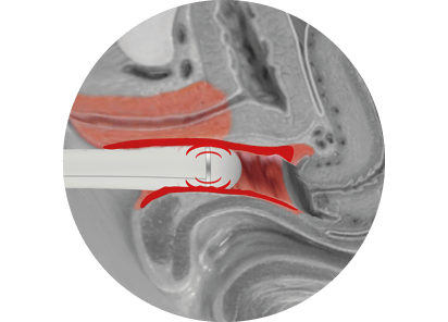 Tissue scan before treatment for EMfemme 360 feminine health treatment in Amsterdam