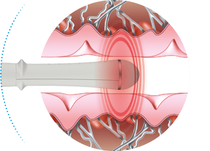 Illustration of the applicator treating the tissue for EMfemme 360 feminine health treatment in Amsterdam
